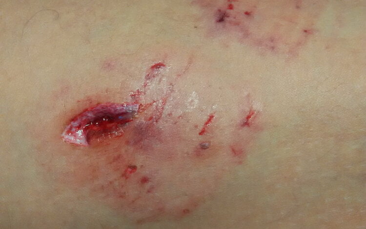 Жителя Корабельного района искусали собаки, напавшие на него целой сворой | Корабелов.ИНФО image 3