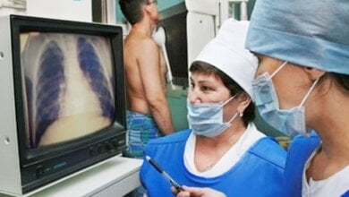 Покласти кінець туберкульозу прагнуть, як і у всьому світі, лікарі у Корабельному районі Миколаєва | Корабелов.ИНФО