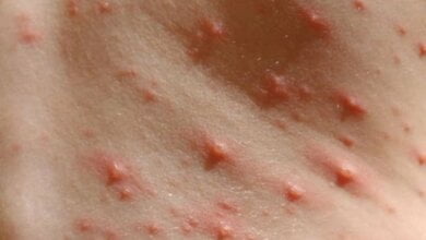 "Защитить может только вакцинация": в Николаевской области от кори умер восьмилетний ребенок, - Минздрав | Корабелов.ИНФО