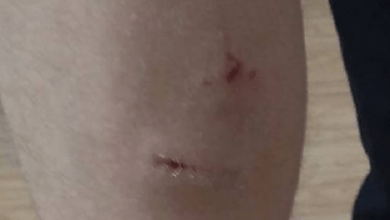 «У меня нет слов! Сама буду прибивать», - жительница Николаева, ребёнка которой возле школы укусила бродячая собака | Корабелов.ИНФО