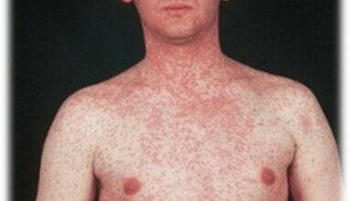 Серед мешканців Корабельного району більше 115 дорослих і близько 30 дітей захворіли на кір за І квартал | Корабелов.ИНФО