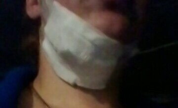 "Врач только развёл руками": после удаления зуба в Корабельном районе, пациентке пришлось делать операцию на челюсти | Корабелов.ИНФО image 1