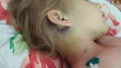 7-летней девочке, которая в Корабельном районе упала с 3-метровой высоты и сломала шею, требуется помощь | Корабелов.ИНФО image 1