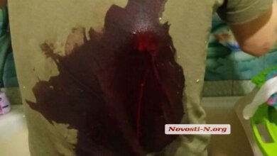 Дела семейные: в Николаеве жена в ходе ссоры с мужем всадила ему в спину кухонный топорик | Корабелов.ИНФО