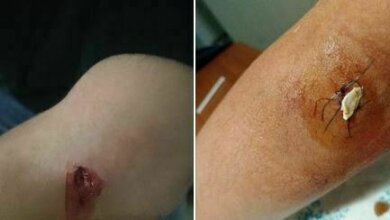 В Николаеве опять собака укусила ребенка | Корабелов.ИНФО