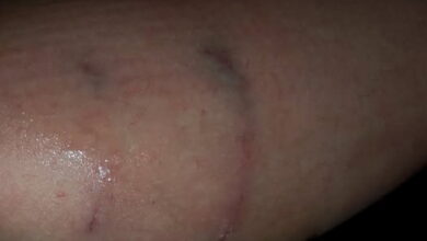 Собака покусала дівчинку