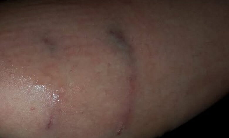 Собака покусала дівчинку