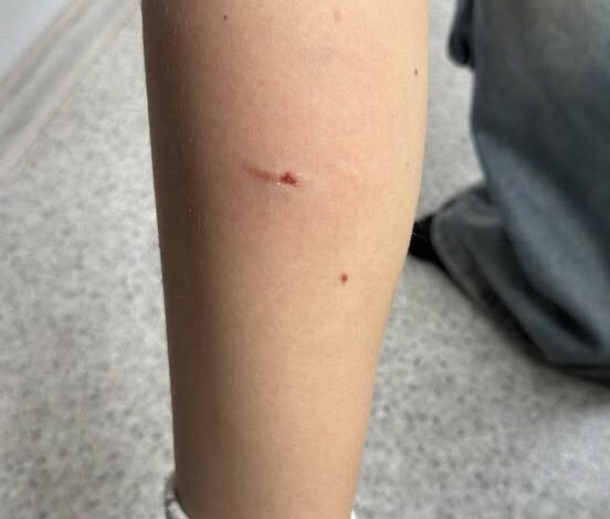 Укус собаки